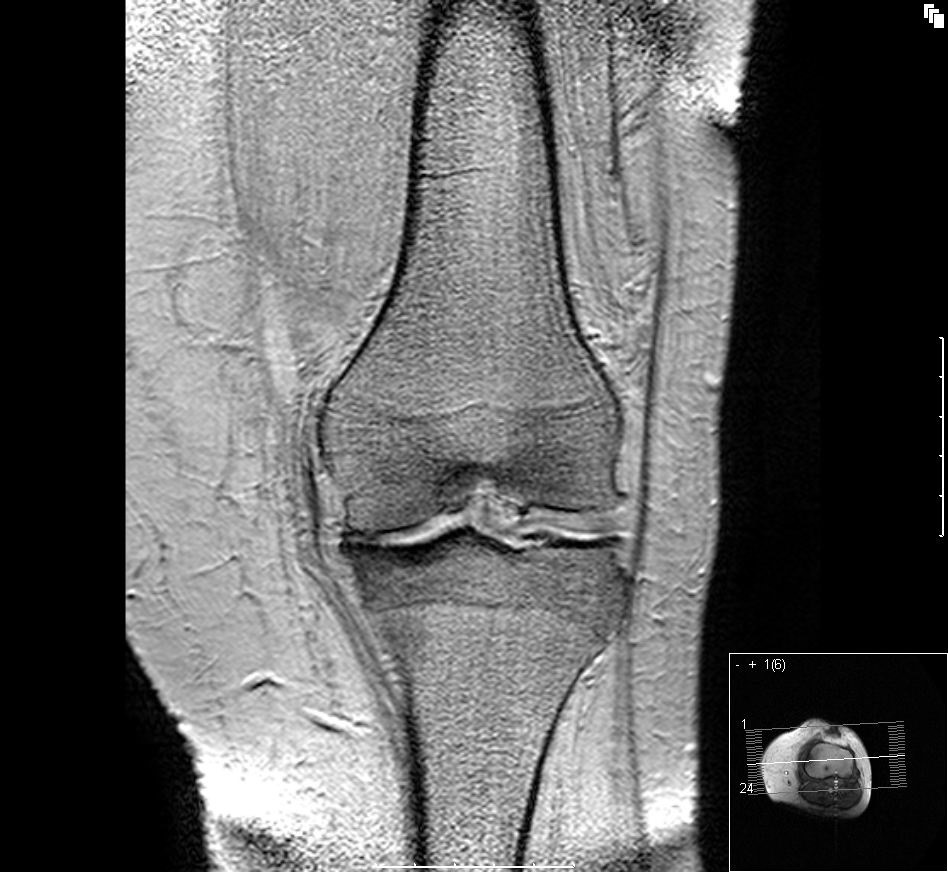 Calzado biomecánico reduce el dolor de la artrosis de la rodilla