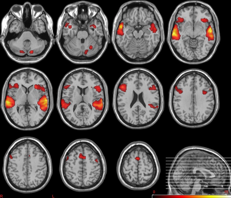 Los cambios cerebrales en pacientes con alzhéimer pueden aparecer 20 años del diagnóstico