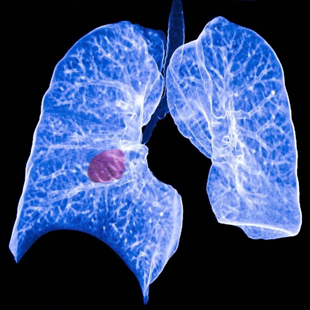 Un hallazgo abre la puerta a un tratamiento para un tipo de cáncer de pulmón agresivo