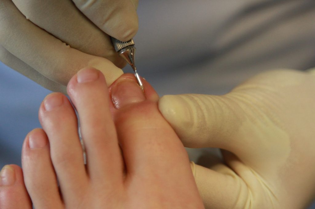 Mujer amputada por infectarse en una pedicura recibirá un millón 750 mil dólares