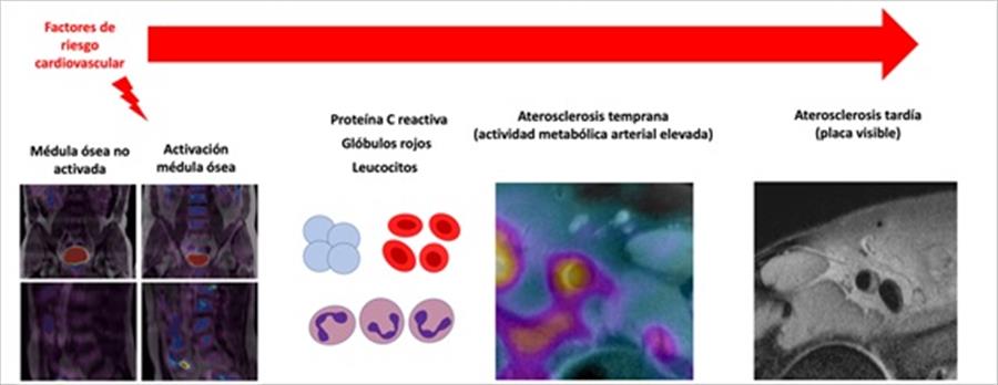 La médula ósea está implicada en el desarrollo de la aterosclerosis