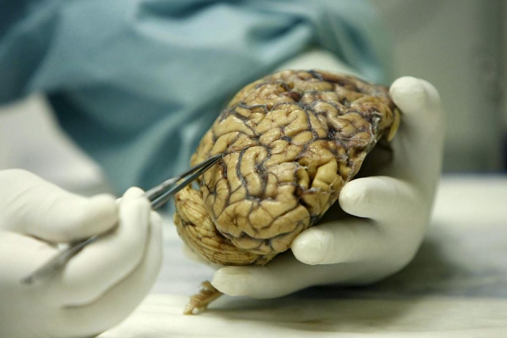 Identificadas 75 regiones del genoma asociadas a la enfermedad de Alzheimer