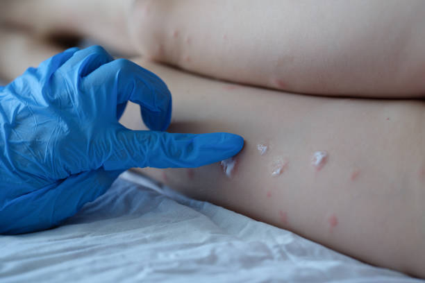 OMS decide que viruela del mono no es una emergencia sanitaria internacional