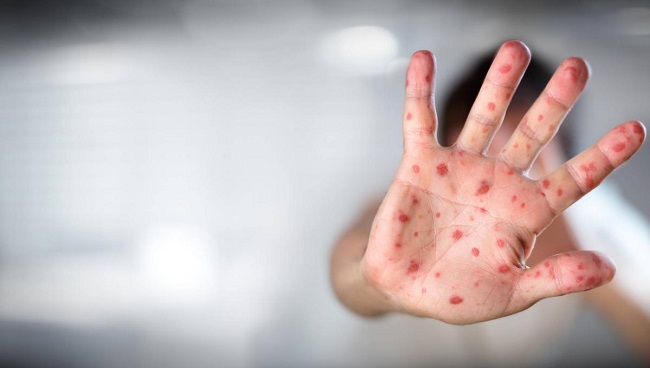OMS dice que el brote de viruela del mono se debe a contagio entre personas