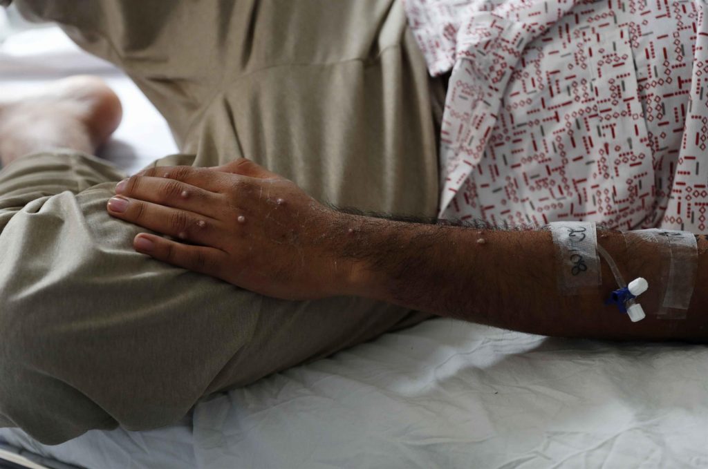 Casos globales de viruela del mono sobrepasan los 50 mil