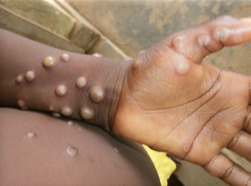 10 preguntas y respuestas sobre Mpox